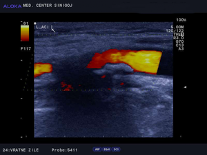 Ultrazvok vratnih žil - ateroskleroza notranje karotidne arterije  vzdolžno