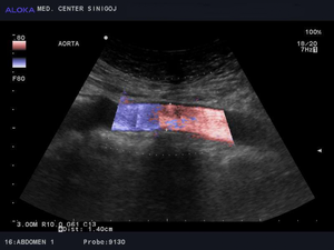 Ultrazvok žil trebuha - abdominalna aorta  normalen izvid