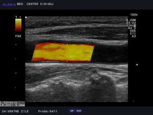 Ultrazvok vratnih žil - energijski dopler skupne karotide