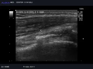Ultrazvok rame - kalcinacija ob tetivi bicepsa, nad njo vidimo panus (zadebelitev sinovialne ovojnice mišice) - ESWT indikacija