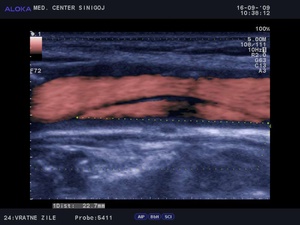 Ultrazvok vratnih žil - disekcija karotide 22 7mm