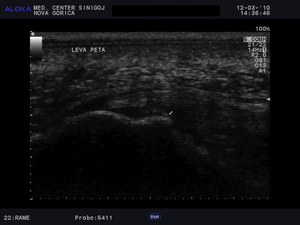 Ultrazvok pete - trn petnice  spina calcanea  indikacija ESWT 2