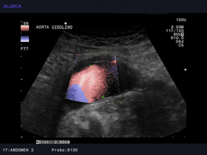 Ultrazvok žil trebuha - anevrizma abdominalne aorte