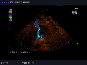 Ultrazvok možganskih žil - vertebralni arteriji  normalen izvid