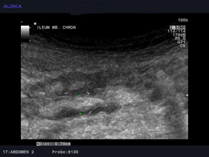 Ultrazvok prebavil - stena ileuma pri Chronovi bolezni
