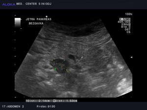 Ultrazvok trebušne slinavke - povečana bezgavka ob pankreasu