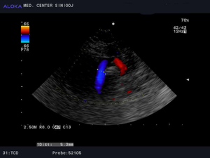 Ultrazvok možganskih žil - vertebralna arterija  normalen izvid