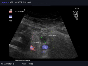 Ultrazvok trebušne slinavke - bezgavka ob glavi pankreasa