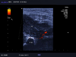 Ultrazvok mišice - mezenhimski tumor  miosarkom