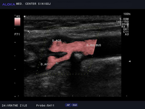 Ultrazvok vratnih žil - zožitev bulbusa in notranje karotidne arterije 2