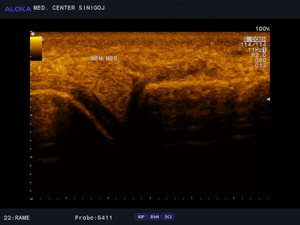Ultrazvok kolena - medialni meniskus  normalen izvid
