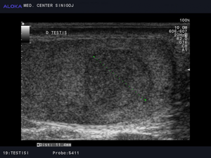 Ultrazvok testisov- tumor desnega testisa