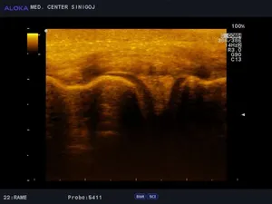 Ultrazvok kolena - počen meniskus