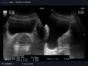 Ultrazvok prostate - benigna hipertrofija prostate 3