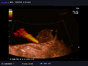 Ultrazvok mehurja 12, Tumor mehurja in jet urina iz levega ostija 