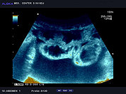Ultrazvok trebuha 3, Prosta tekočina v trebuhu (ascites)
