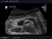 Ultrazvok trebušne slinavke 1, Trebušna slinavka (pankreas)