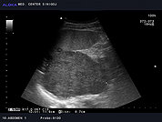 Ultrazvok ledvic 5, Tumor ledvice