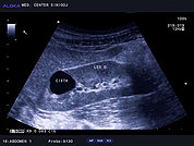 Ultrazvok ledvic 24, Enostavna cista ledvice