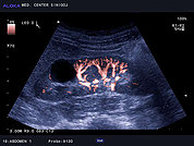 Ultrazvok ledvic 12, Enostavna cista ledvice, barvni dopler ledvične cirkulacije