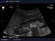 Ultrazvok ledvic 13, Ledvični kamen v pielonu