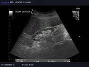 Ultrazvok ledvic 15, Kronična parenhimska okvara ledvice in zmanjšana ledvica