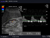Ultrazvok ledvic 19, Kronična parenhimska okvara ledvice, povišan RI (rezistenčni indeks)