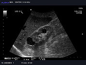 Ultrazvok ledvic 22, Enostavni cisti v ledvici, začetna kronična parenhimska okvara ledvic