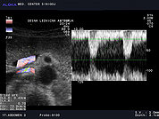 Ultrazvok ledvične arterije 3, Barvni in pulzni dopler desne ledvične arterije -normalen izvid