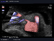Ultrazvok ledvične arterije 4, Ozka desna ledvična arterija
