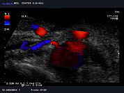 Ultrazvok ledvične arterije 5, Barvni dopler ledvične arterije (energijski, power doppler)