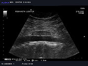 Ultrazvok ledvic 25, Podkvasta ledvica nad abdominalno aorto