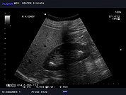 Ultrazvok ledvic 26, Ledvični kamen v kaliksu zgornje in spodnje skupine