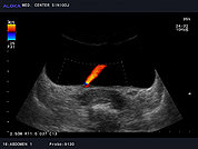 Ultrazvok mehurja 3, Normalen jet urina iz desnega ostija
