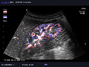 Ultrazvok ledvic 17, barvni dopler ledvičnega ožilja ledvic (color dopler)