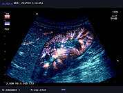 Ultrazvok ledvic 18, barvni dopler ledvične cirkulacije (color dopler)
