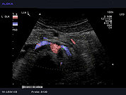 Ultrazvok ledvične arterije 9, Ultrazvok desne in leve ledvične arterije (normalen izvid)