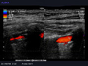 Ultrazvok vratnih žil 43, Prirojeno ožja desna vertebralna arterija