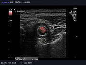Ultrazvok vratnih žil 9, Opornica ali stent v karotidni arteriji