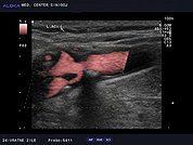 Ultrazvok vratnih žil 1, Zožitev bulbusa in notranje karotidne arterije