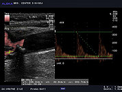 Ultrazvok vratnih žil 3, Hemodinamsko pomembna zožitev notranje karotidne arterije