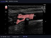 Ultrazvok vratnih žil 5, Zožitev bulbusa in notranje karotidne arterije 