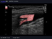 Ultrazvok vratnih žil 10, Aterosklerotični plak v notranji karotidni arteriji