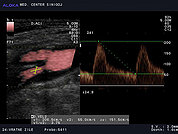Ultrazvok vratnih žil 11, Maščobni plak v notranji karotidni arteriji