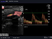 Ultrazvok vratnih žil 17, Zožitev notranje karotidne arterije s povišanimi hitrostmi