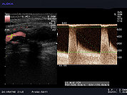 Ultrazvok vratnih žil 16, Zožitev notranje karotidne arterije s povišanimi hitrostmi