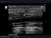 Ultrazvok vratnih žil 19, Opornica (stent) v karotidni arteriji