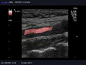 Ultrazvok vratnih žil 20, Ateroskleroza karotidne arterije