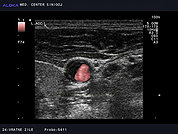 Ultrazvok vratnih žil 22, Ateroskleroza skupne karotidne arterije