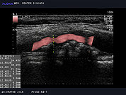 Ultrazvok vratnih žil 24, Ateroskleroza karotidne arterije